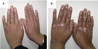 Neural and Endocrinal Pathobiochemistry of Vitiligo: Comparative Study for a Hypothesized Mechanism